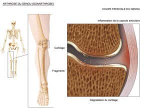 Sympt Mes Et Diagnostic De La L Sion Cartilagineuse Dr Paillard