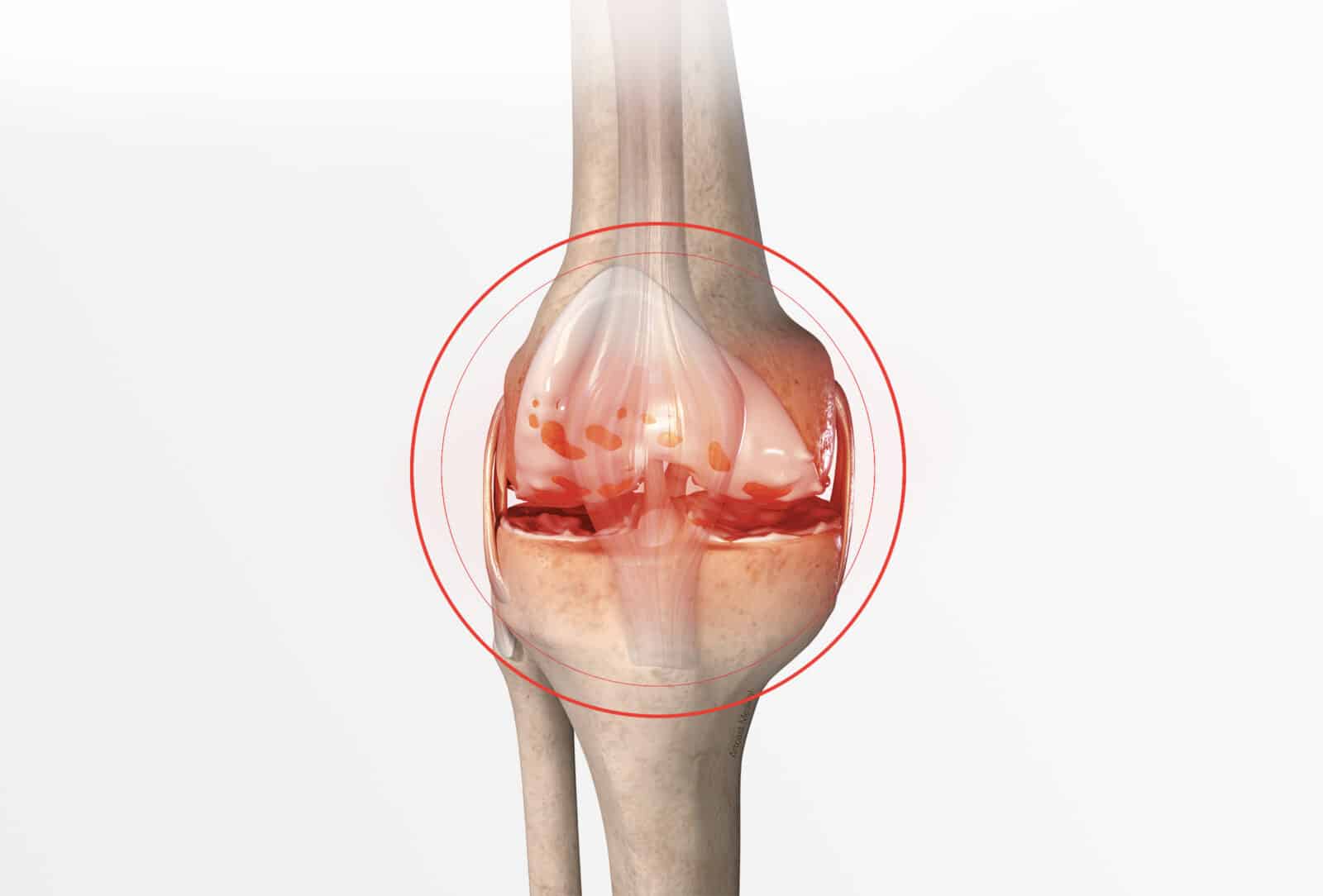 Arthrose du genou : gonarthrose