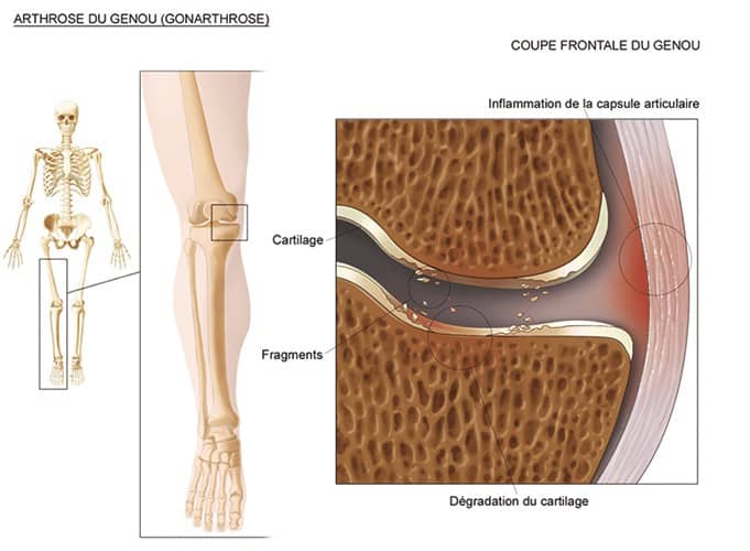 Arthrose du genou : gonarthrose
