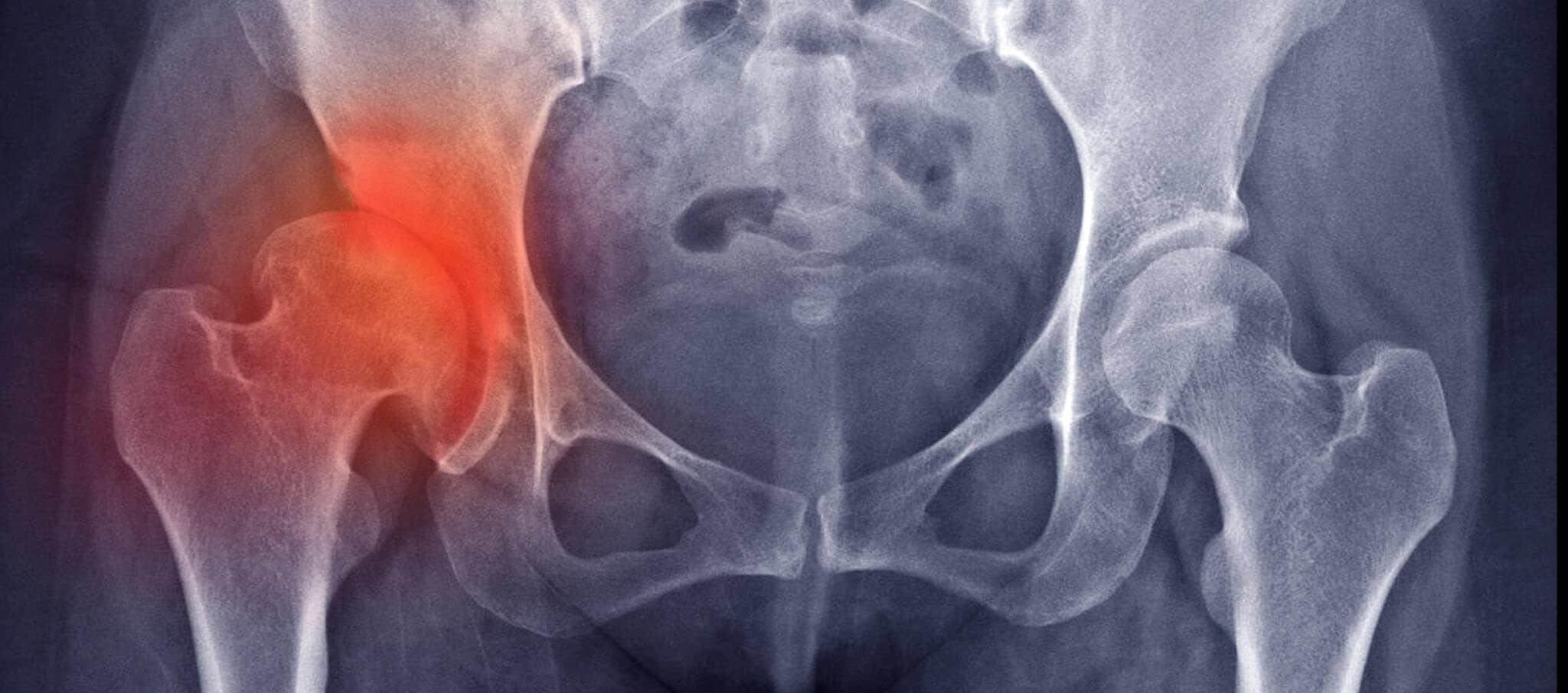 Comment soulager l'arthrose du genou ?, Dr Paillard